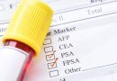 Jednostavan test otkriva rak prostate. 98% se izliječi ako ga otkriju na vrijeme
